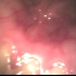 肛門科 腸内カメラ・脱糞 ○撮2 【lahaina-1447】【スカトロ/脱糞】